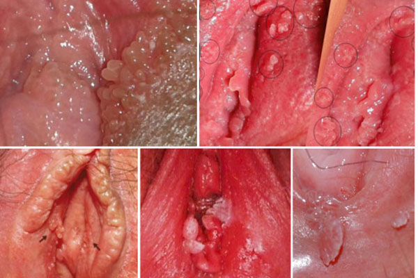 Hình sùi mào gà ở nữ giới