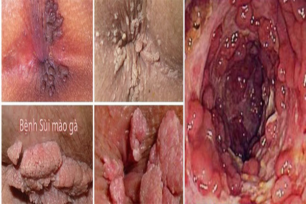 Sùi mào gà nằm bên trong và ngoài ống hậu môn