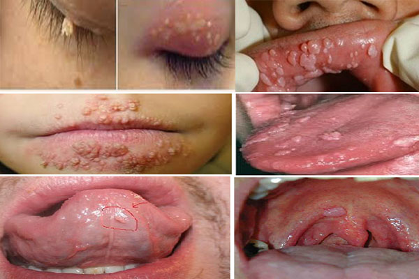 Sùi mào gà ở mắt, môi, miệng, lưỡi