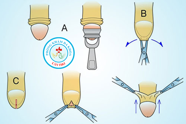 các bước cắt bao quy đầu an toàn nhất