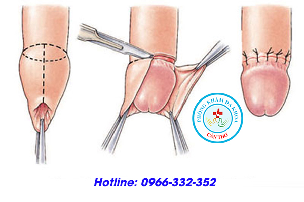 cắt bao quy đầu là gì