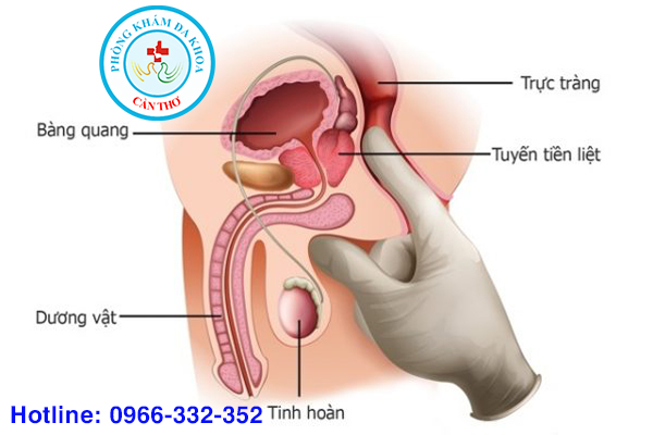 viêm tuyến tiền liệt là bệnh gì